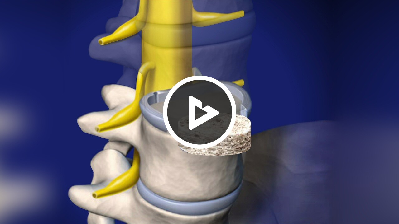 Alif Procedure Incision ALIF: Anterior Lumbar Interbody Fusion (with bone graft and metal plate)
