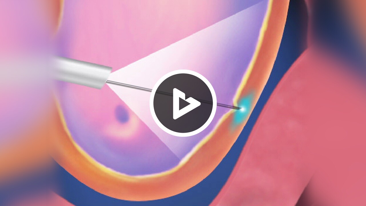 Botulinum Toxin (BOTOX®) Injections for Overactive Bladder (Female)