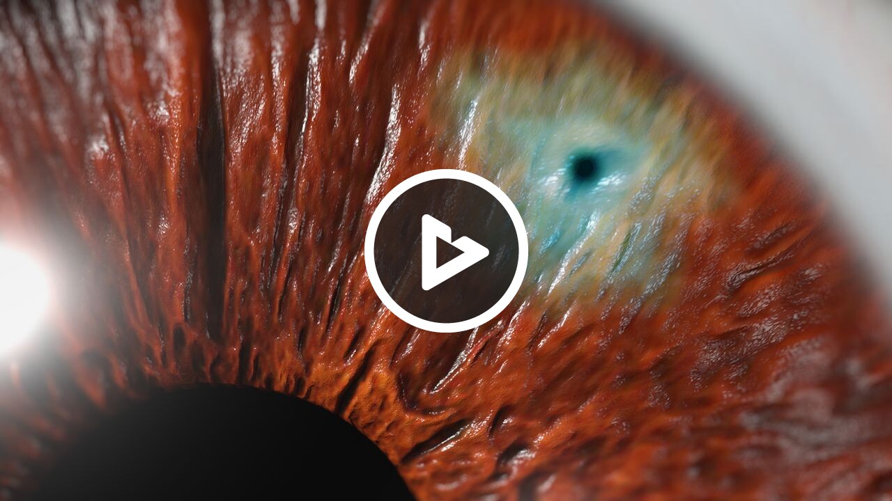 Laser Peripheral Iridotomy (LPI)