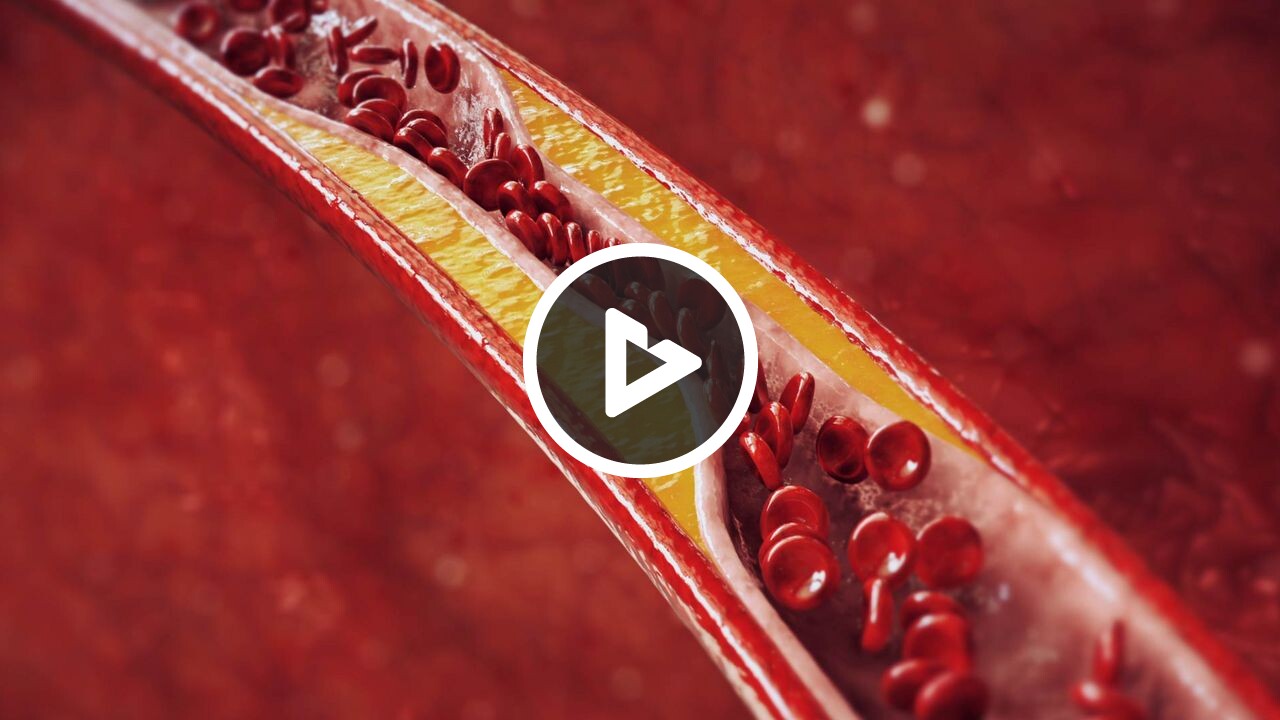 Peripheral Vascular Disease (PVD)