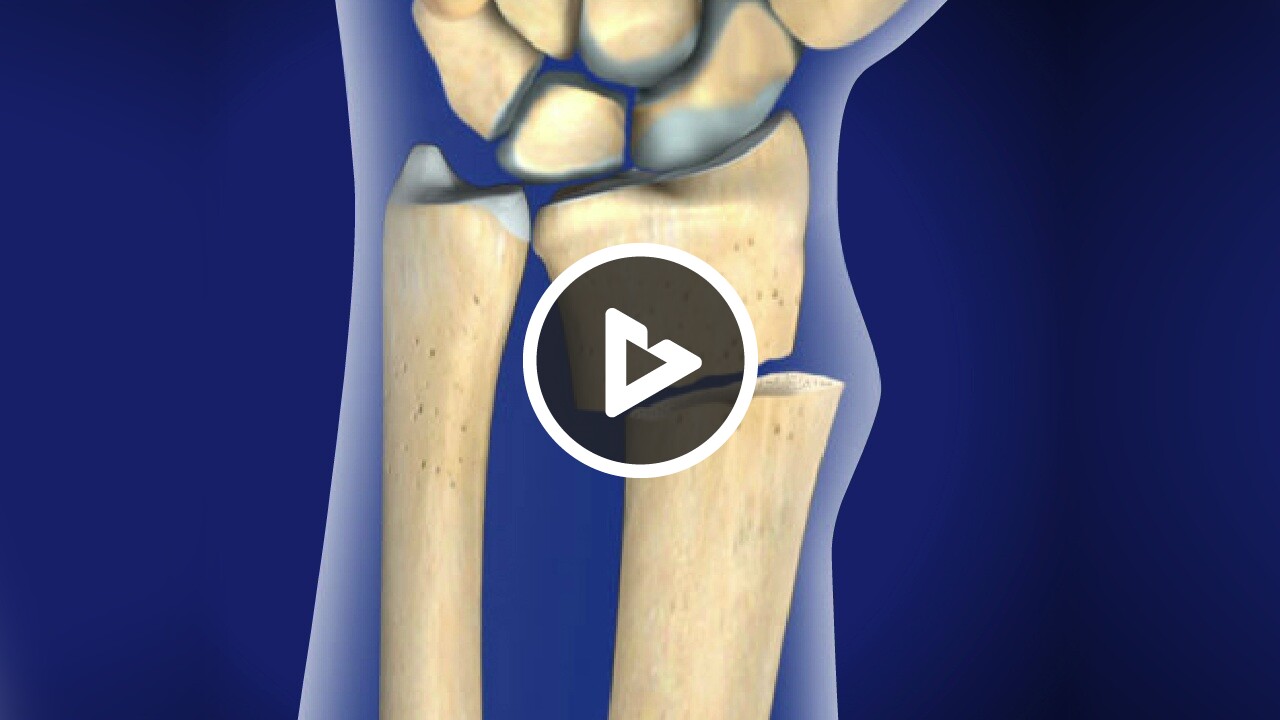 Distal Radius Fracture Repair with Volar Plate
