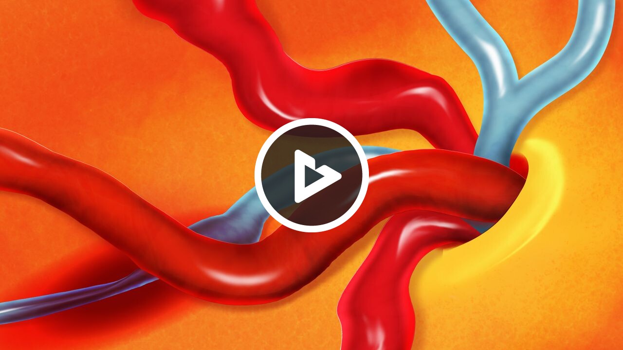 Retinal Vein Occlusion (RVO)